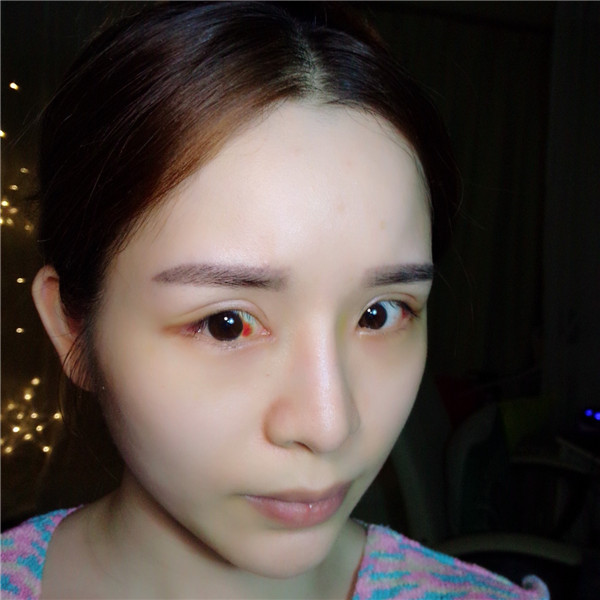 【双眼皮手术】终于去做了心心念念的双眼皮手术啦~~来看看我的案例吧!我没开眼角哦,宝宝们你们开眼角了没?