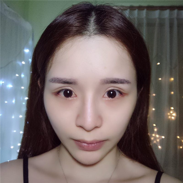 【双眼皮手术】终于去做了心心念念的双眼皮手术啦~~来看看我的案例吧!我没开眼角哦,宝宝们你们开眼角了没?