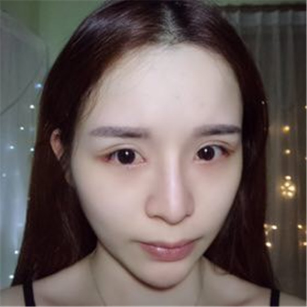 【双眼皮手术】终于去做了心心念念的双眼皮手术啦~~来看看我的案例吧!我没开眼角哦,宝宝们你们开眼角了没?