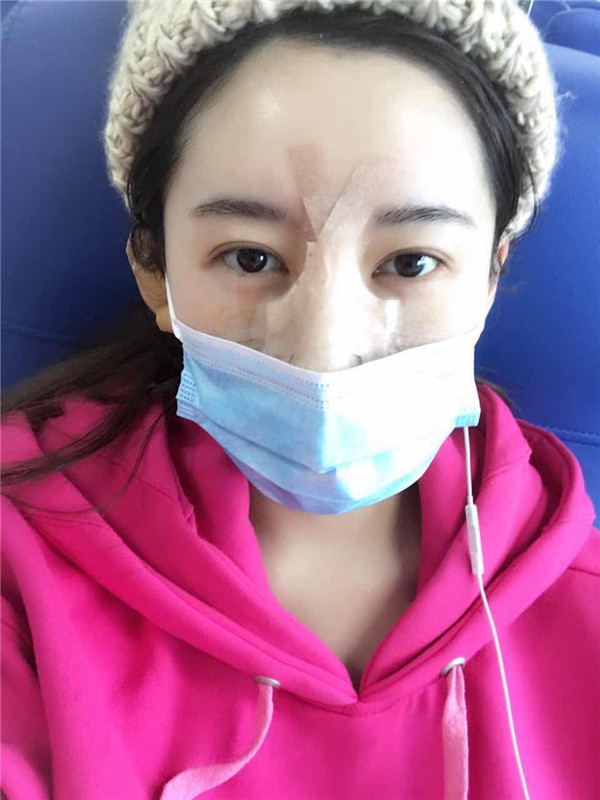 【硅胶隆鼻+耳软骨垫鼻尖】想让自己更完美就去做了隆鼻手术,果还较为的不错,和大家分享一下我的案例!