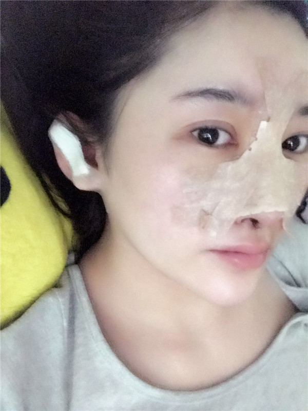 【硅胶隆鼻+耳软骨垫鼻尖】想让自己更完美就去做了隆鼻手术,果还较为的不错,和大家分享一下我的案例!