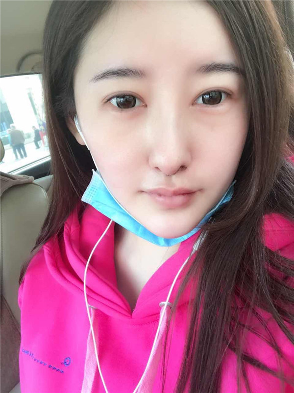 【硅胶隆鼻+耳软骨垫鼻尖】想让自己更完美就去做了隆鼻手术,果还较为的不错,和大家分享一下我的案例!