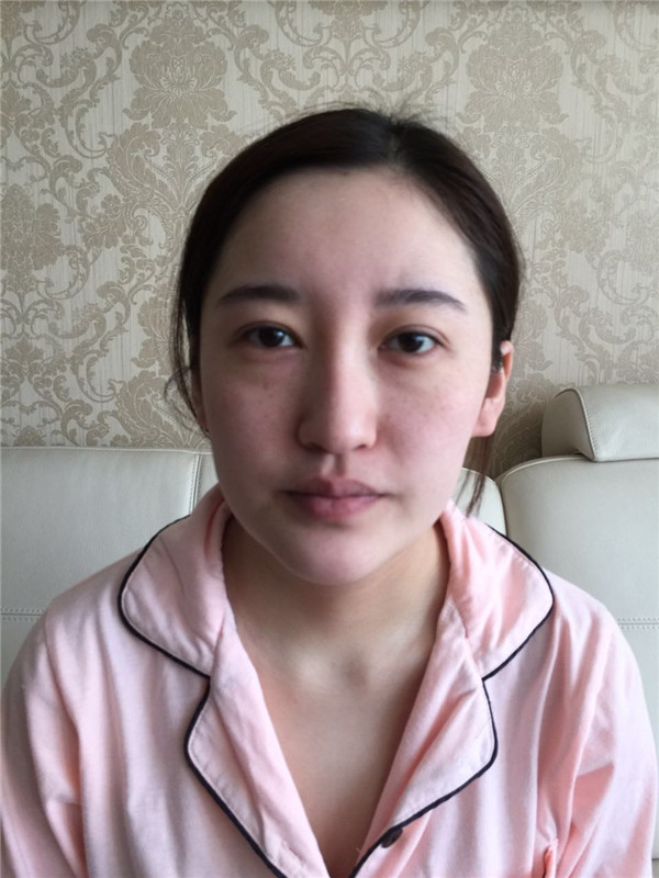【硅胶隆鼻+耳软骨垫鼻尖】想让自己更完美就去做了隆鼻手术,果还较为的不错,和大家分享一下我的案例!