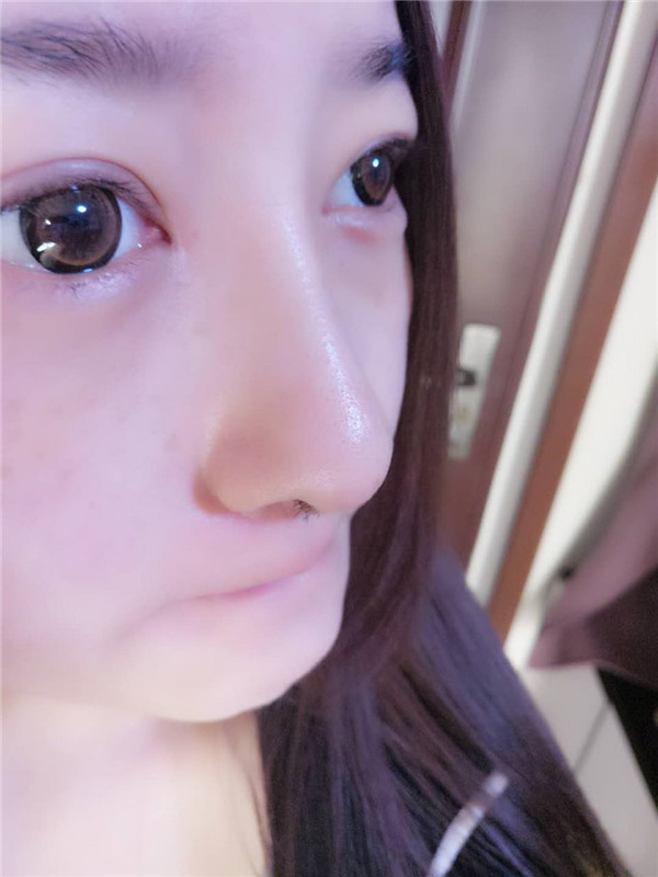 【硅胶隆鼻+耳软骨垫鼻尖】想让自己更完美就去做了隆鼻手术,果还较为的不错,和大家分享一下我的案例!