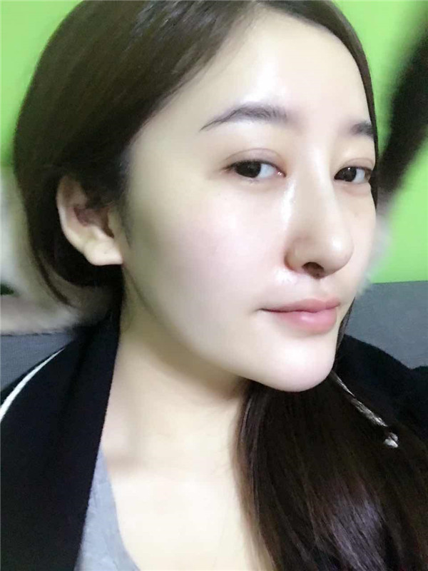 【硅胶隆鼻+耳软骨垫鼻尖】想让自己更完美就去做了隆鼻手术,果还较为的不错,和大家分享一下我的案例!
