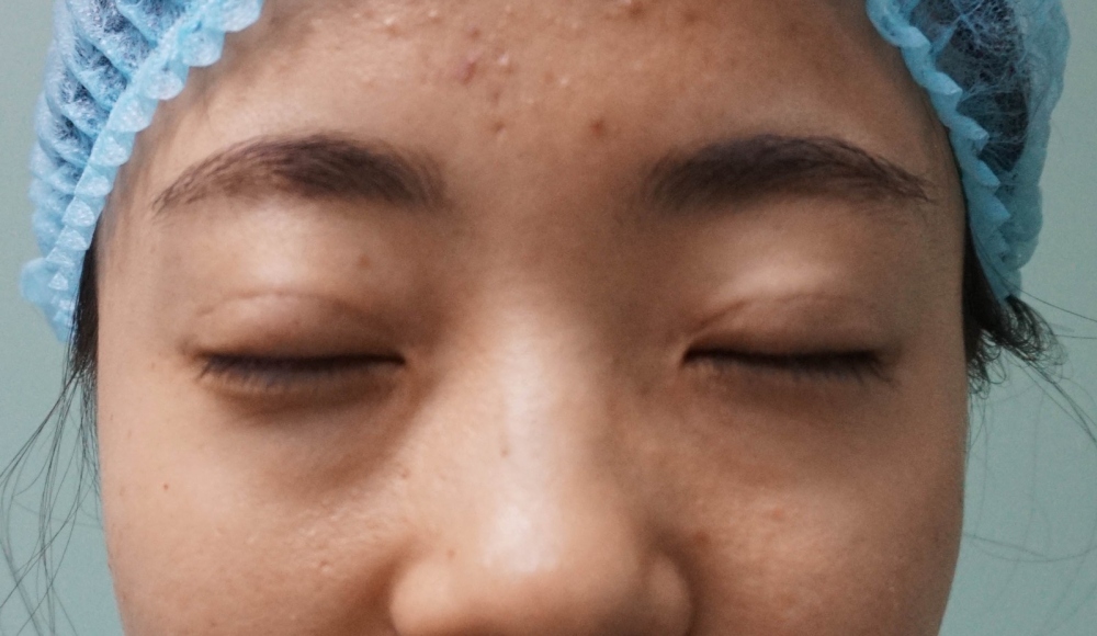 姐妹们,来看看我的双眼皮修复案例吧!看我修复的怎么样?之前失败的双眼皮手术给我留下了阴影,简直是花钱买罪受!