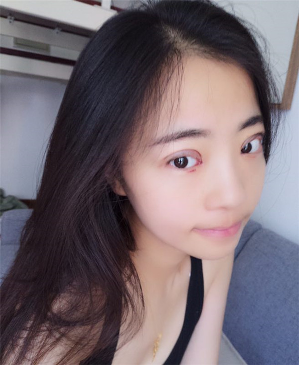 姐妹们,来看看我的双眼皮修复案例吧!看我修复的怎么样?之前失败的双眼皮手术给我留下了阴影,简直是花钱买罪受!