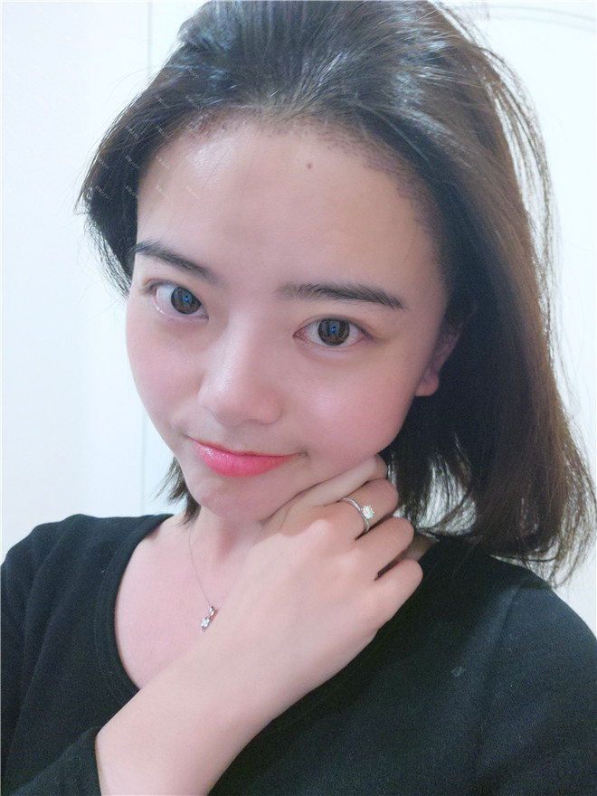 脱发种植发际线真人案例分享!你有脱发的情况吗?快来看看别人家的脱发是如何治疗的吧!