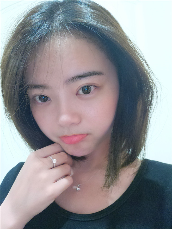 脱发种植发际线真人案例分享!你有脱发的情况吗?快来看看别人家的脱发是如何治疗的吧!
