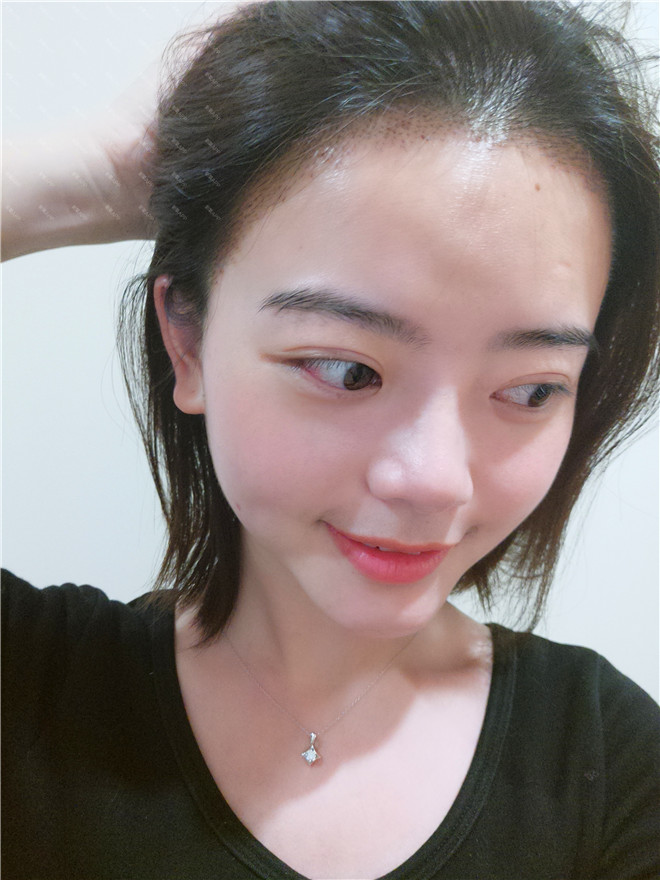 脱发种植发际线真人案例分享!你有脱发的情况吗?快来看看别人家的脱发是如何治疗的吧!