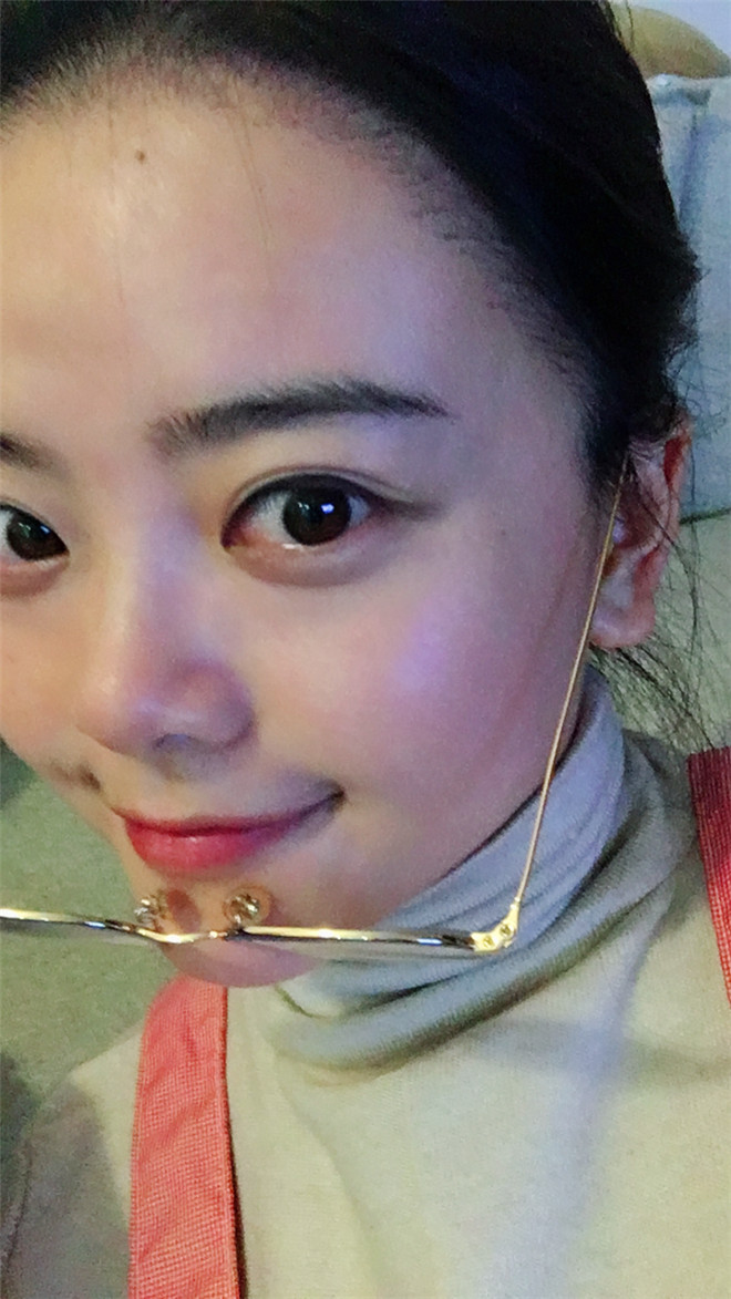 脱发种植发际线真人案例分享!你有脱发的情况吗?快来看看别人家的脱发是如何治疗的吧!