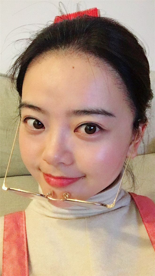 脱发种植发际线真人案例分享!你有脱发的情况吗?快来看看别人家的脱发是如何治疗的吧!