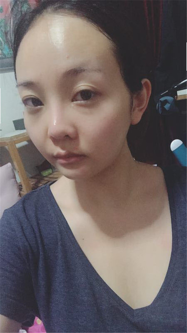 分享我的自体脂肪面部填充经历,我以前的面部情况真的是属于面部凹陷很严重的,整个人看起来真的很憔悴,自从做了面填之后就真的完全改善了我的样貌!