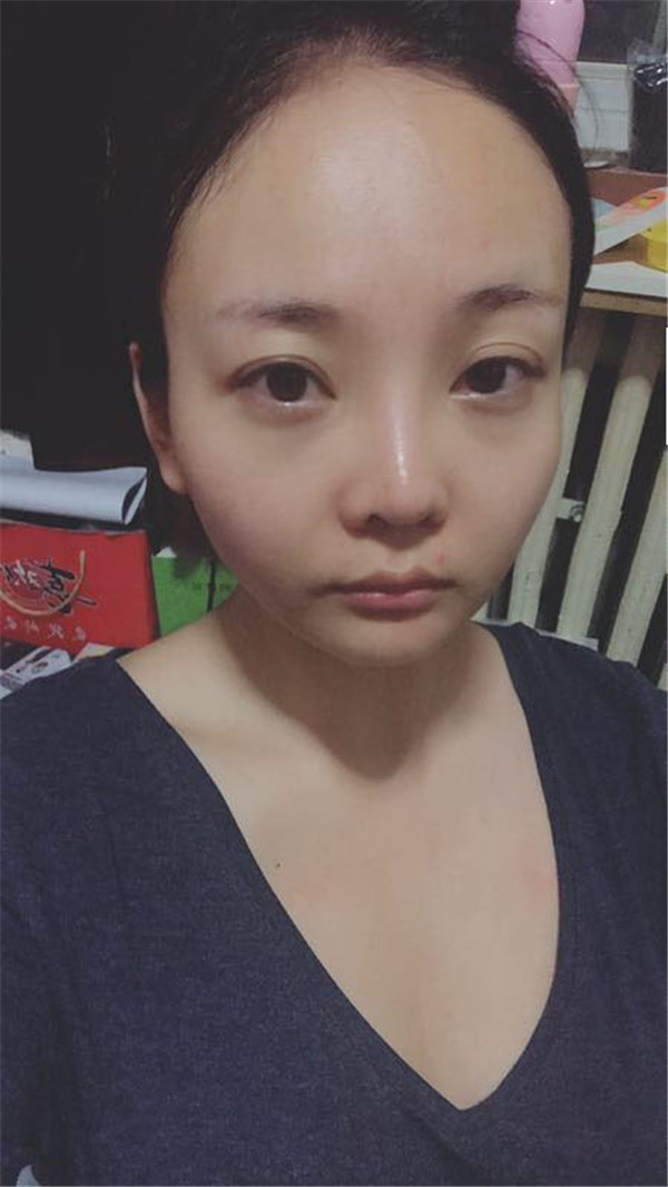 分享我的自体脂肪面部填充经历,我以前的面部情况真的是属于面部凹陷很严重的,整个人看起来真的很憔悴,自从做了面填之后就真的完全改善了我的样貌!
