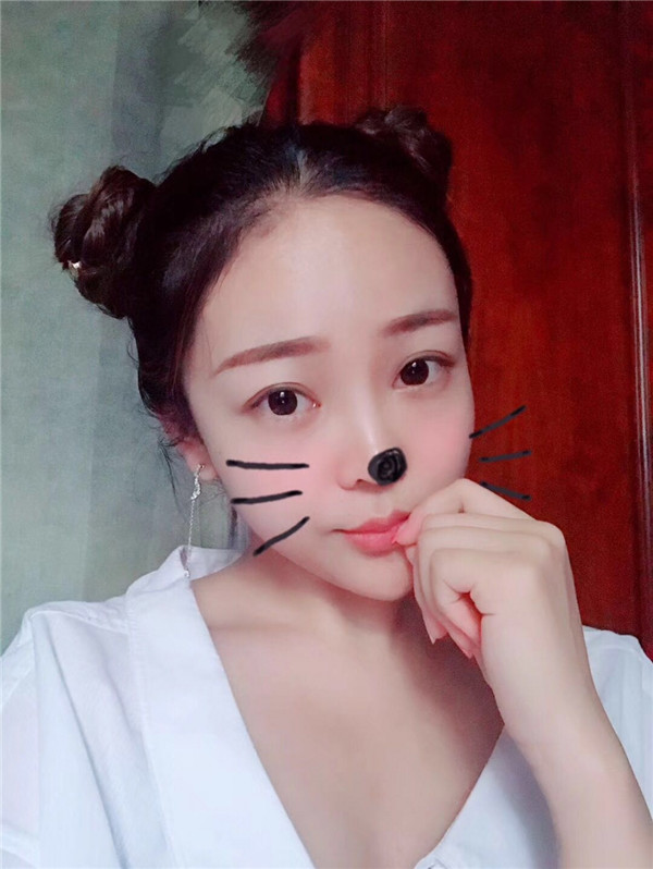 分享我的自体脂肪面部填充经历,我以前的面部情况真的是属于面部凹陷很严重的,整个人看起来真的很憔悴,自从做了面填之后就真的完全改善了我的样貌!
