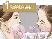 做埋线提升,问老公,一问全剧终!