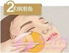 做埋线提升,问老公,一问全剧终!