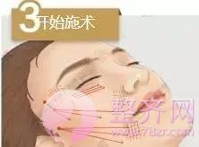 做埋线提升,问老公,一问全剧终!