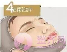 做埋线提升,问老公,一问全剧终!
