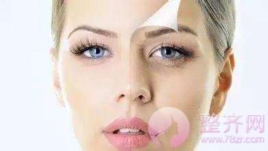 做埋线提升,问老公,一问全剧终!