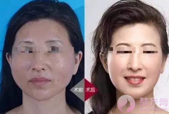 做埋线提升,问老公,一问全剧终!