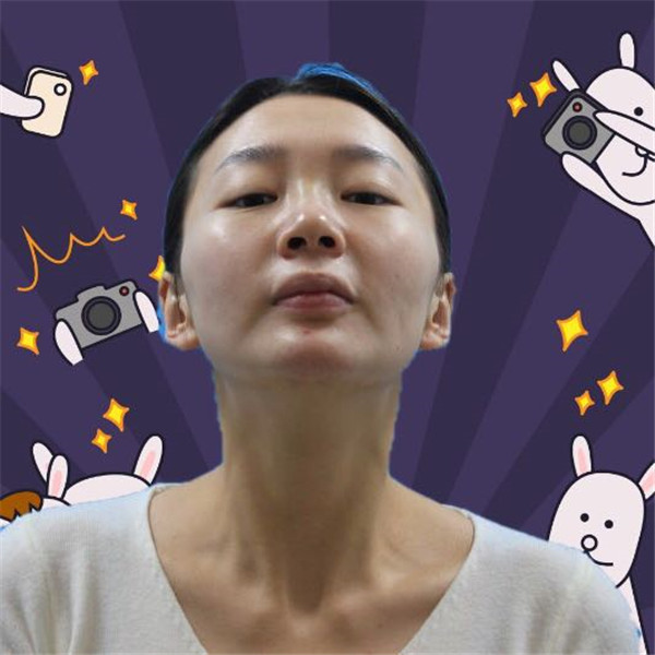 快过年啦!我来分享我的自体肋骨垫鼻尖+硅胶假体经历啦~~~姐妹们,我终于做了我心心念的鼻子啦,看看我的分享吧