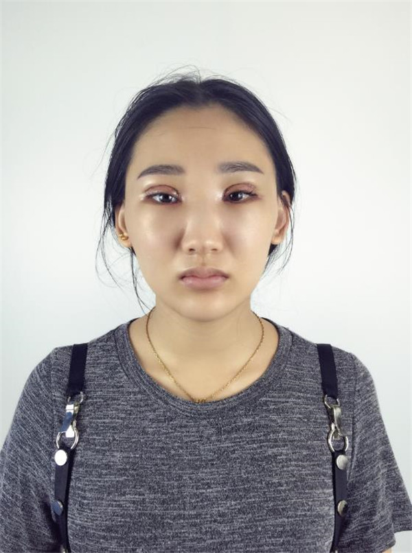 【割双眼皮+开眼角分享】哈喽,我较近去做了双眼皮外加开内眼角,其实我是很怕的,但是为了漂亮再拍也要克服啦!!
