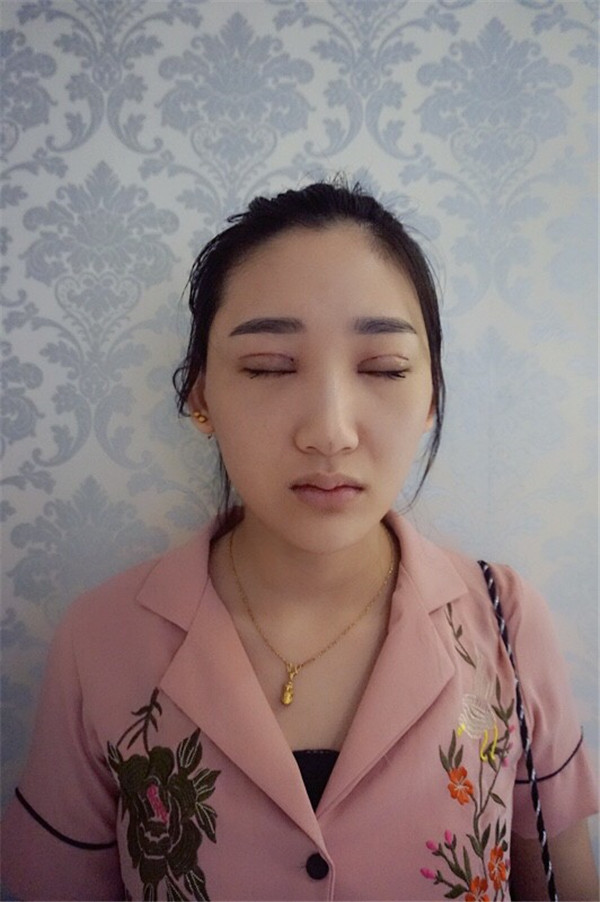 【割双眼皮+开眼角分享】哈喽,我较近去做了双眼皮外加开内眼角,其实我是很怕的,但是为了漂亮再拍也要克服啦!!