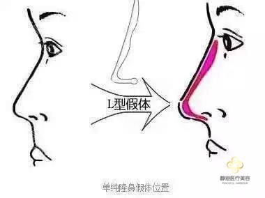 隆鼻失败后如何修复果较好?