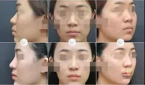 隆鼻失败后如何修复果较好?