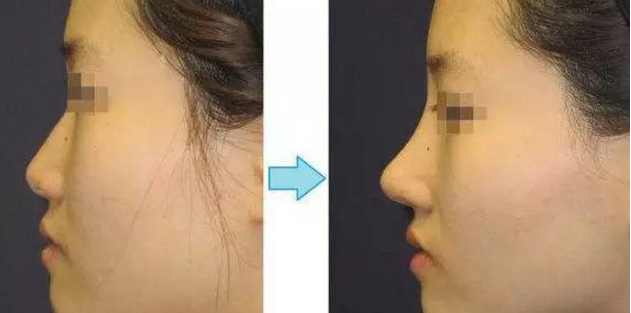 达拉斯综合隆鼻技术和其他鼻部手术区别在哪?