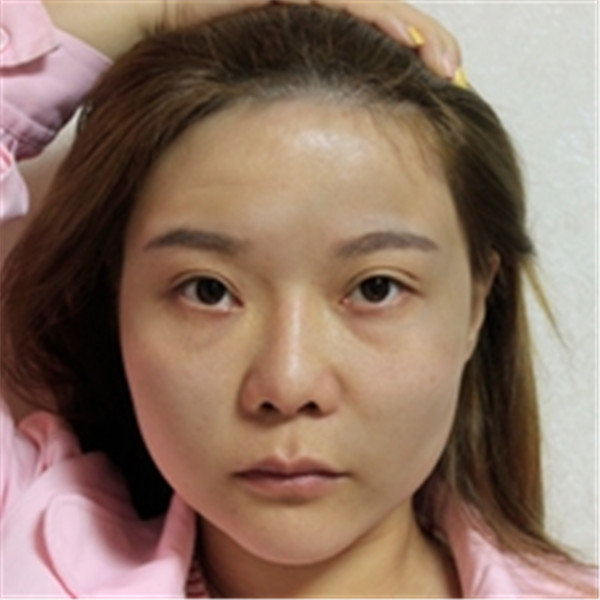 姐妹们,我做了【自体脂肪填充脸部】。填充部位有:太阳穴、眉弓、额头、面颊、泪沟、下巴。哈哈来看看我的变化吧~~