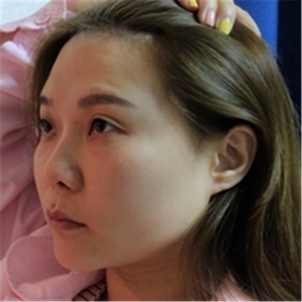 姐妹们,我做了【自体脂肪填充脸部】。填充部位有:太阳穴、眉弓、额头、面颊、泪沟、下巴。哈哈来看看我的变化吧~~