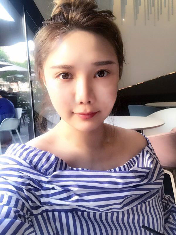 姐妹们,我做了【自体脂肪填充脸部】。填充部位有:太阳穴、眉弓、额头、面颊、泪沟、下巴。哈哈来看看我的变化吧~~