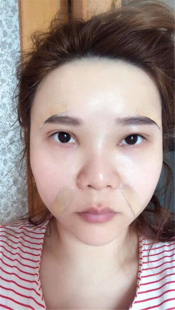 姐妹们,我做了【自体脂肪填充脸部】。填充部位有:太阳穴、眉弓、额头、面颊、泪沟、下巴。哈哈来看看我的变化吧~~