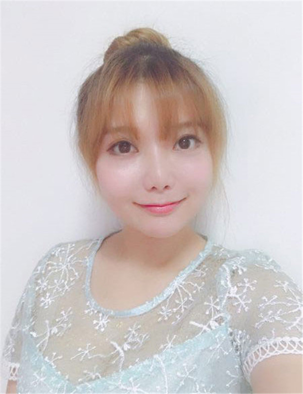 姐妹们,我做了【自体脂肪填充脸部】。填充部位有:太阳穴、眉弓、额头、面颊、泪沟、下巴。哈哈来看看我的变化吧~~