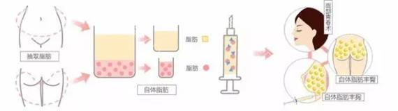 先天胸不够,后天脂肪救~!