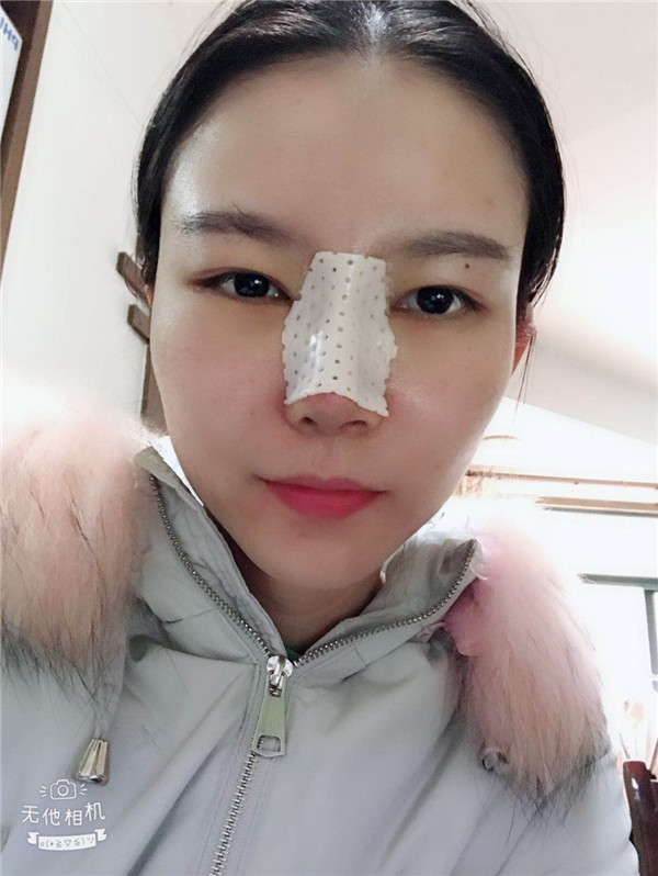 美女们,来看看我的耳软骨隆鼻案例吧!大家进来看看我做的怎么样啊?术后恢复很重要哦~~~
