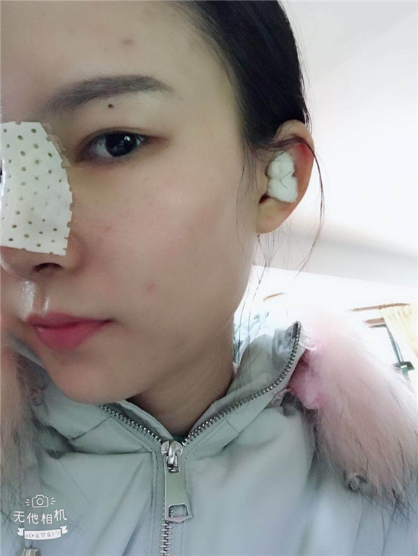 美女们,来看看我的耳软骨隆鼻案例吧!大家进来看看我做的怎么样啊?术后恢复很重要哦~~~