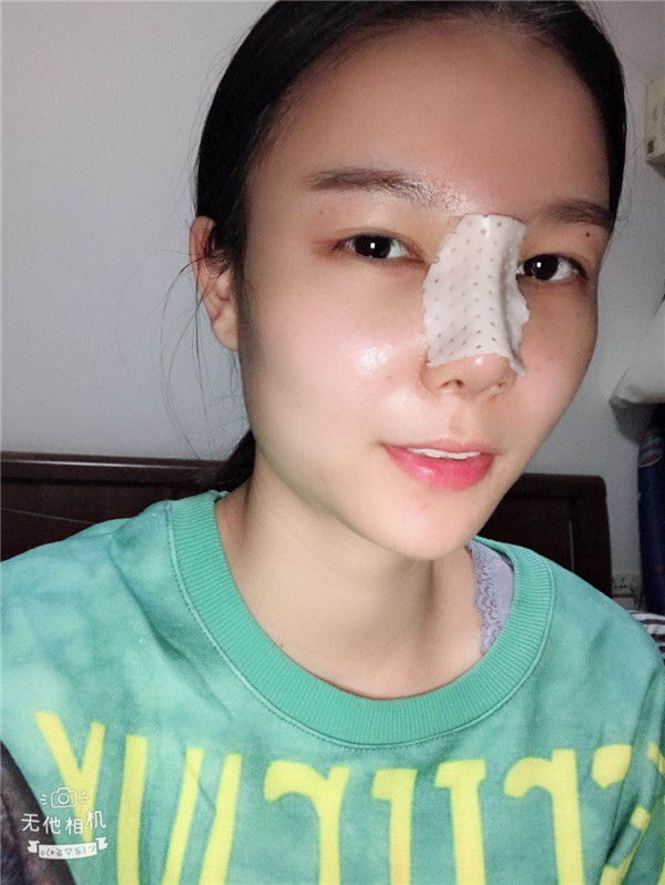 美女们,来看看我的耳软骨隆鼻案例吧!大家进来看看我做的怎么样啊?术后恢复很重要哦~~~