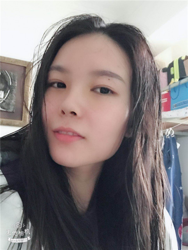 美女们,来看看我的耳软骨隆鼻案例吧!大家进来看看我做的怎么样啊?术后恢复很重要哦~~~