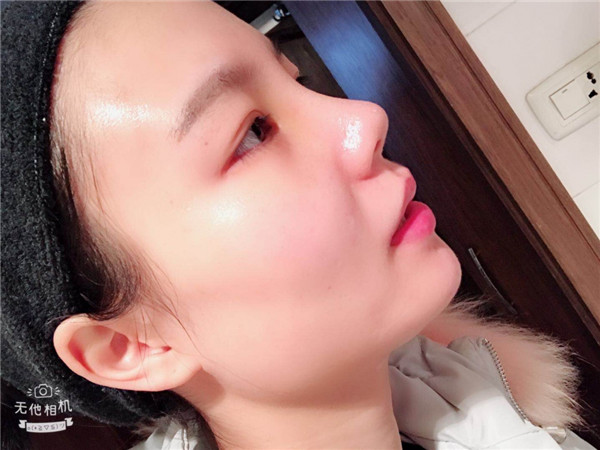 美女们,来看看我的耳软骨隆鼻案例吧!大家进来看看我做的怎么样啊?术后恢复很重要哦~~~