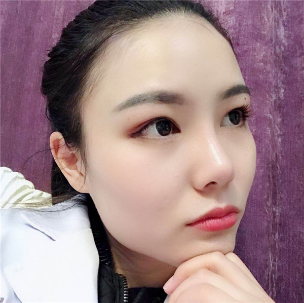 美女们,来看看我的耳软骨隆鼻案例吧!大家进来看看我做的怎么样啊?术后恢复很重要哦~~~