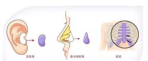 隆鼻十几二十年之后,会怎么样?
