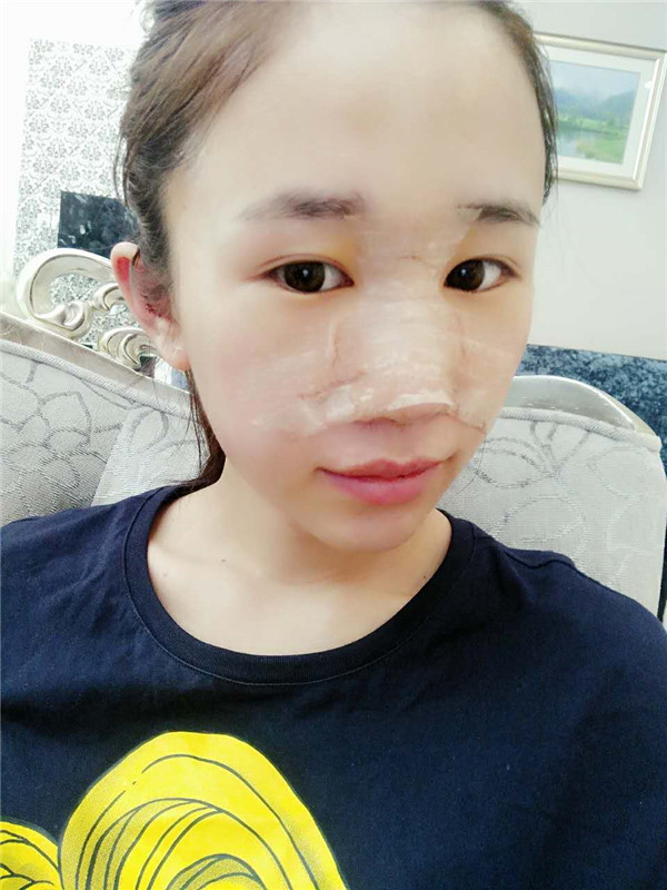 【福建膨体隆鼻】给大家看看我的膨体隆鼻案例,要么不做,要么就做一个好一点的!姐妹们,你们觉得我做的怎么样?