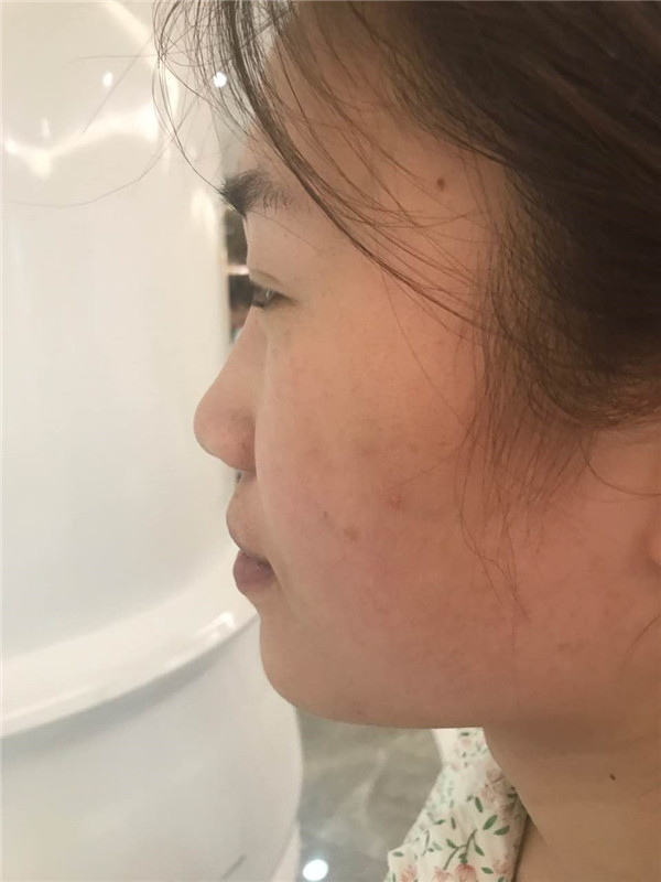 【福建膨体隆鼻】给大家看看我的膨体隆鼻案例,要么不做,要么就做一个好一点的!姐妹们,你们觉得我做的怎么样?