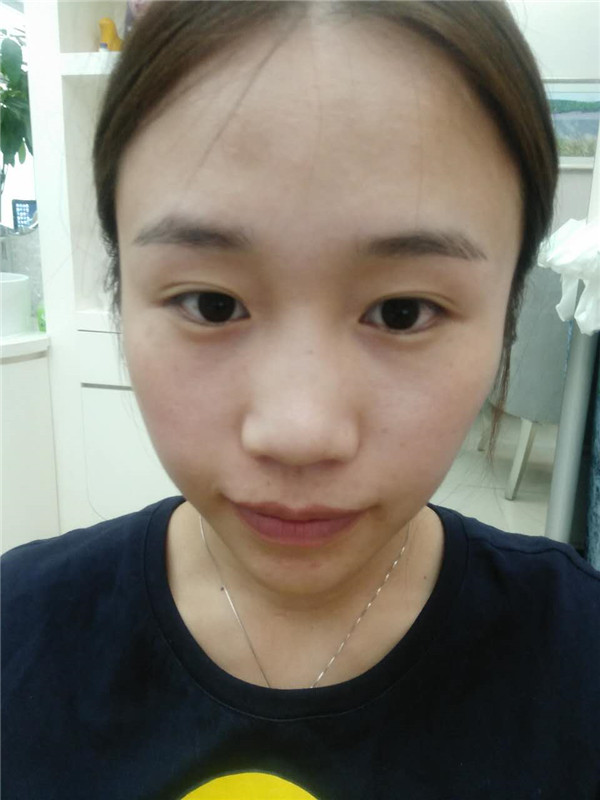 【福建膨体隆鼻】给大家看看我的膨体隆鼻案例,要么不做,要么就做一个好一点的!姐妹们,你们觉得我做的怎么样?