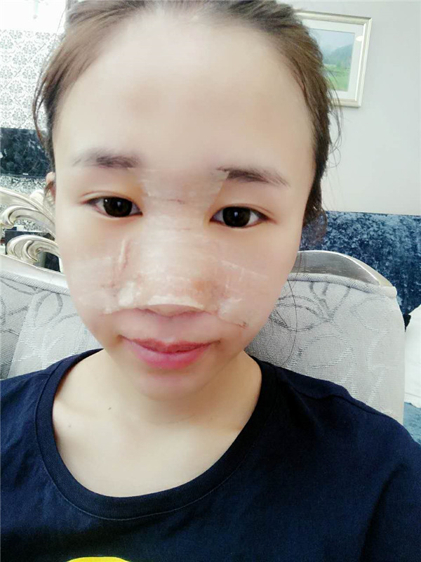 【福建膨体隆鼻】给大家看看我的膨体隆鼻案例,要么不做,要么就做一个好一点的!姐妹们,你们觉得我做的怎么样?