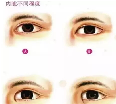 开眼角会回缩?是真的还是谣言?