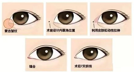 开眼角会回缩?是真的还是谣言?